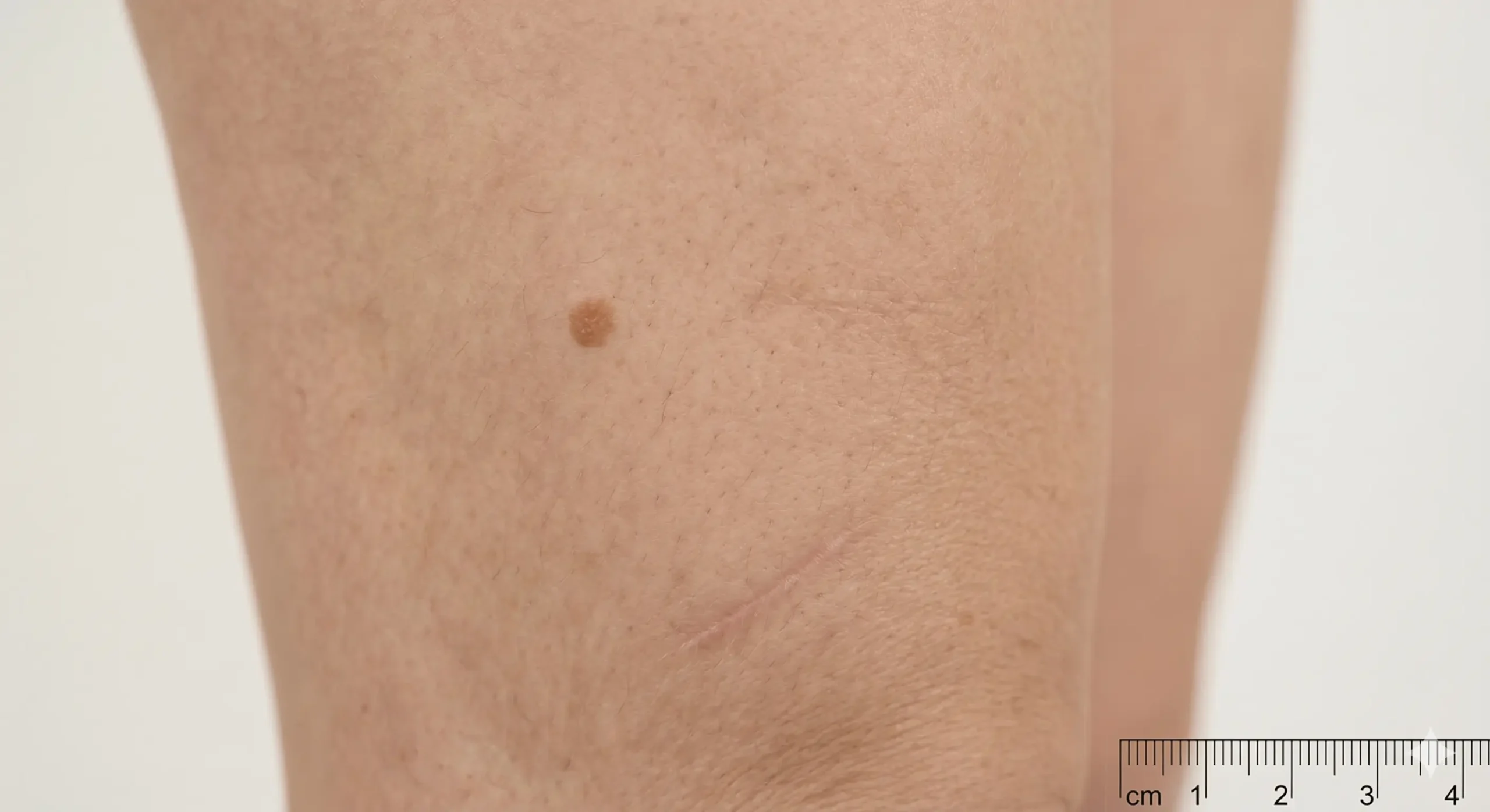 Types de cellulite adipeuse aqueuse fibreuse